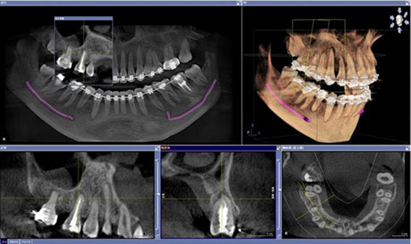 Sirona <br>高解析3D電腦斷層掃描